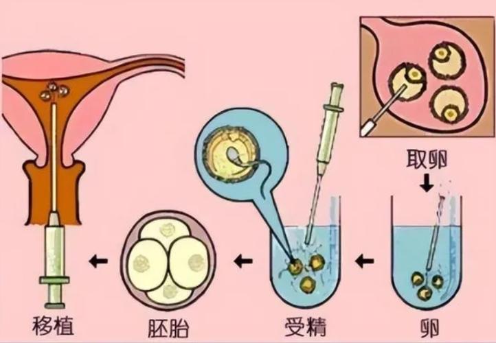供卵试管代怀是什么-供卵试管代怀：解析未来生育选择